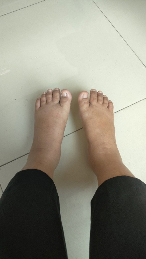 KAKI BENGKAK