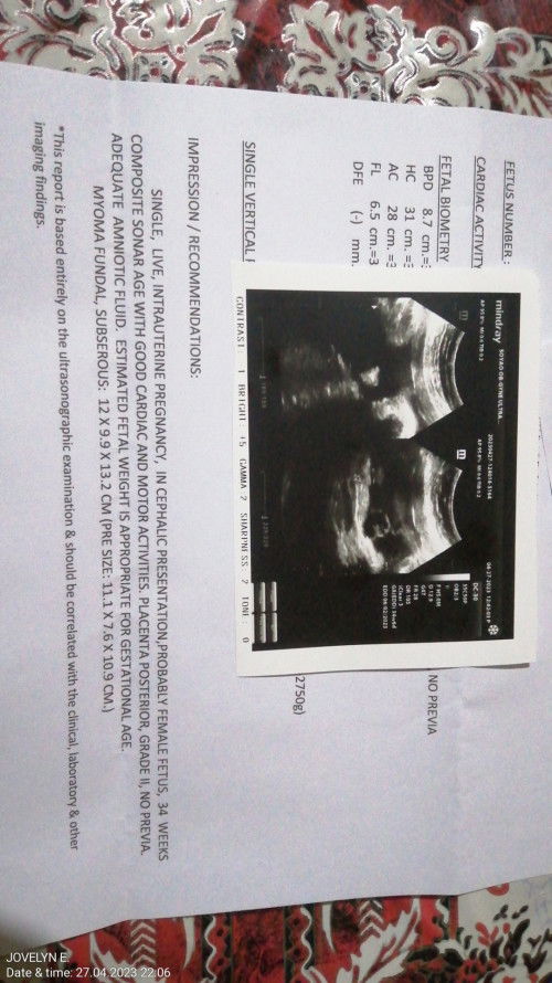 12cm mayoma, Normal delivery ba o CS? Kasi nasa labas naman daw Sabi ni OB ang mayoma ko.