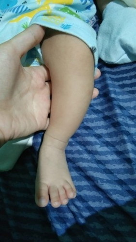Kaki bengkok pada bayi