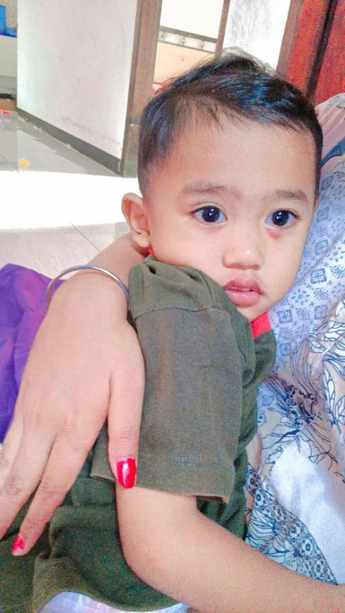 Tentang kalazion atau bintitan