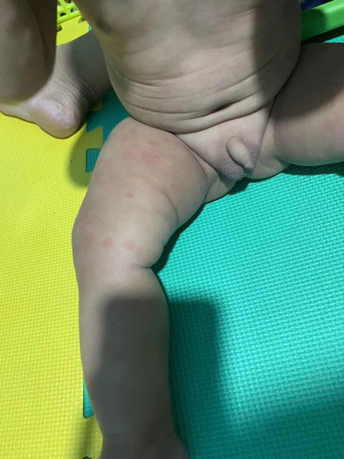 ไข้หัดผื่นขึ้นหลังไข้หาย