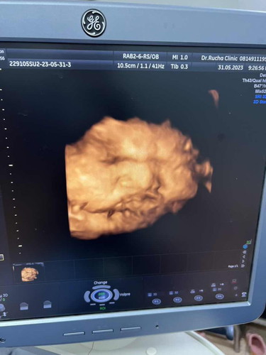 36+2 w น้ำหนักลูก 3,549 ใหญ่ไปมั้ยค่ะแม่ๆอยากคลอดเอง แม่ๆคิดว่าคลอดเองได้มั้ยค่ะ