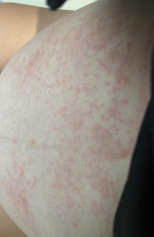 เป็นผื่น คัน แบบนี้ปกติมั๊ย