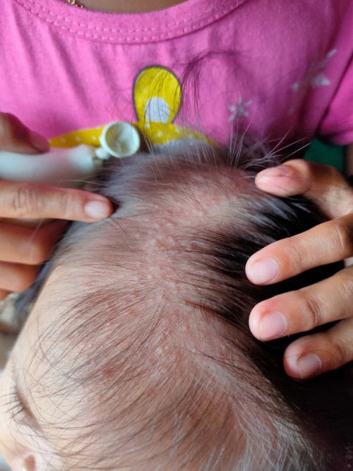 Bentol pada kepala dan tubuh