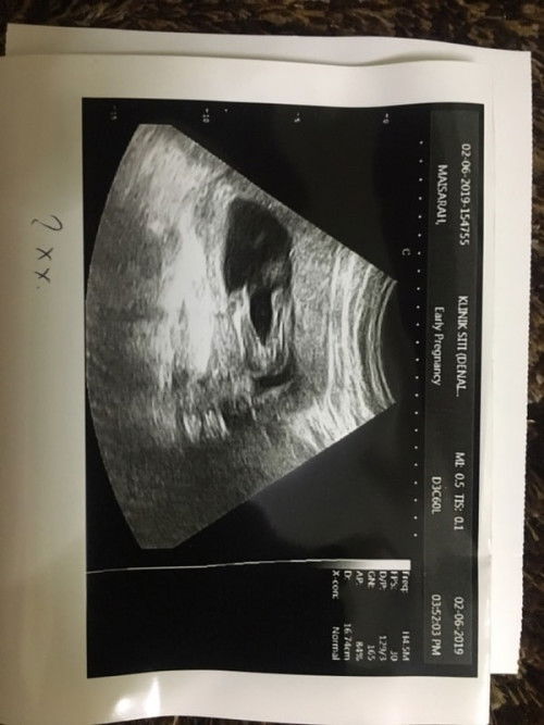 Hi Nak Scan Di Klinik Siti Denai Alam