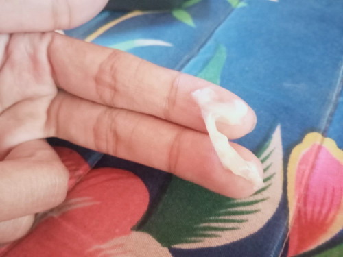 ตั้งครรภ์35+4วีค