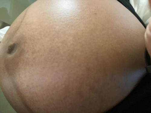 ท้องผิวด่างๆไม่สม่ำเสมอ