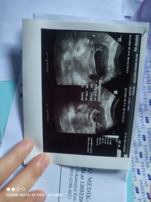 USG 11 W nih bun..bantu jawab ya