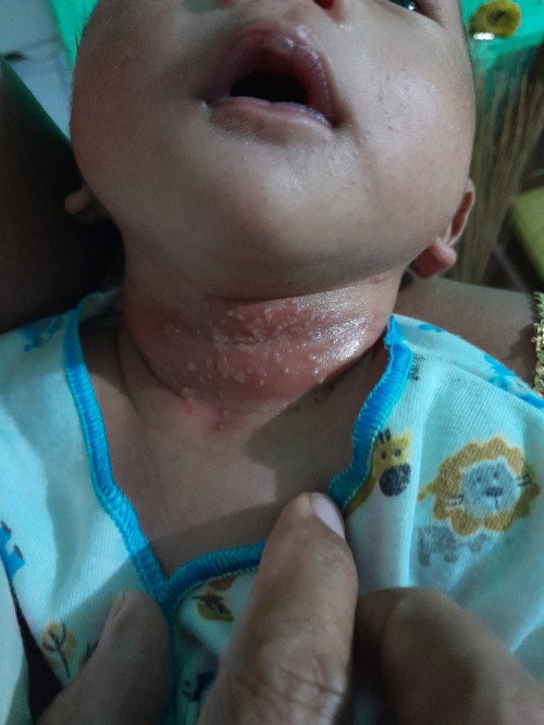 Leher bayi merah dan bintik"