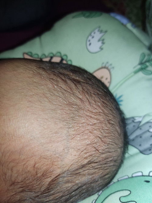 Biang keringat pada kulit rambut bayi usia 1 minggu
