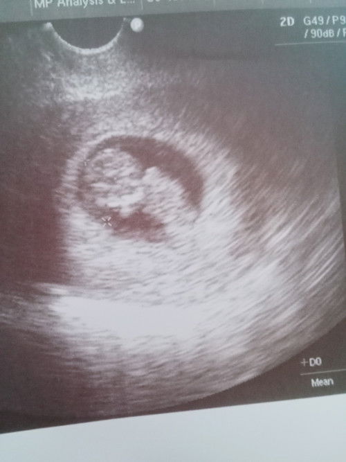 TRANSVAGINAL ULT AT 10WEEKS