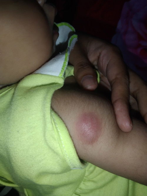 Bekas suntik bcg benjol besar