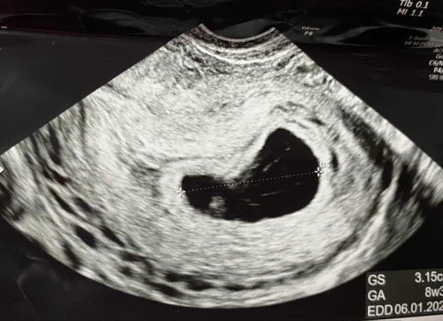 แม่ไปฝากท้องมาแล้วค่าาา🎉