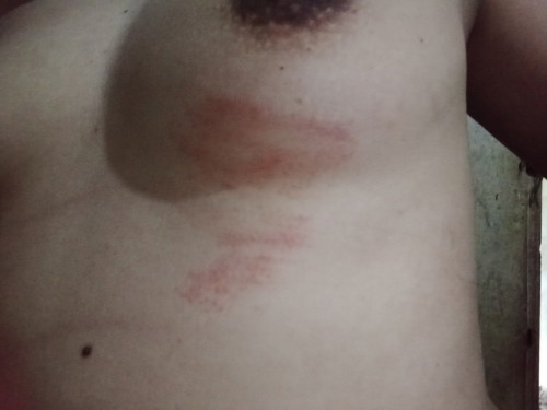Breast problem