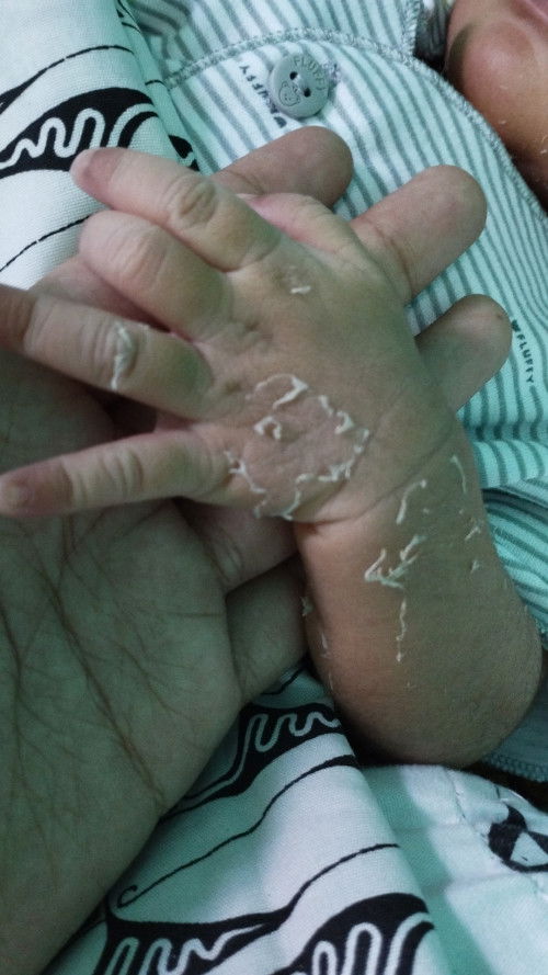 kulit bayi terkelupas