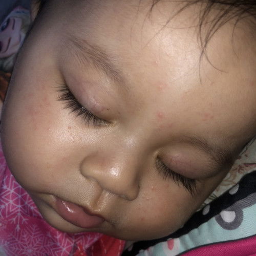 bintik merah bayi 7bulan