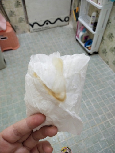 39+3Wไม่ปวดท้องแต่รู้สึกมดลูกบีบตัว