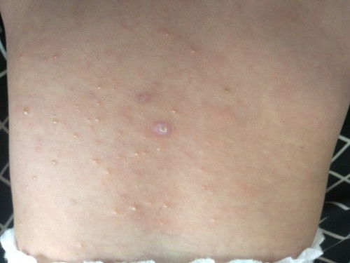 bentol berair pada bayi 4 bulan