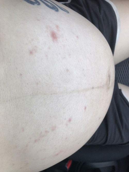 แพ้เหงื่อหรือเปล่า