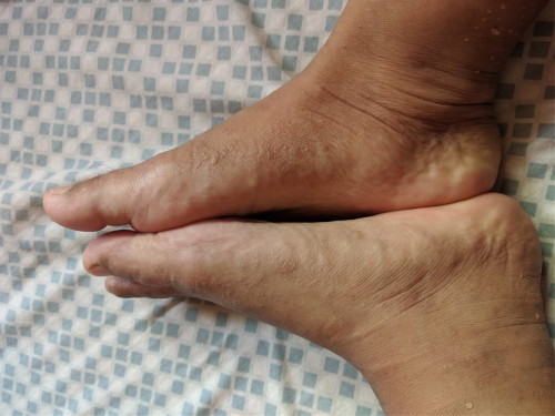 Hi. Can someone help me if ano po tawag dito? And ano po gagawin? Sobrang kati niya as in.