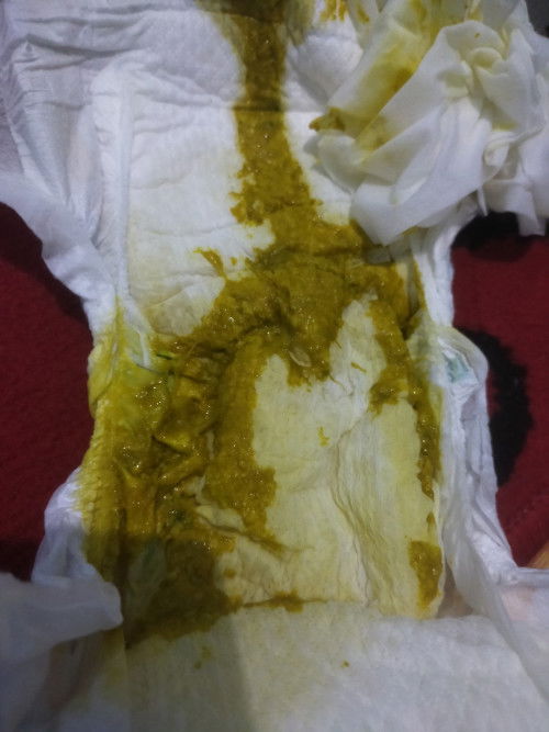 Ada yg pernah ngalami ga kenapa pup bayi 2 bulan seperti ini apakah berbahaya apa tidak yaa