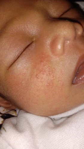 Salep atau cream utk ruam susu di pipi bayi