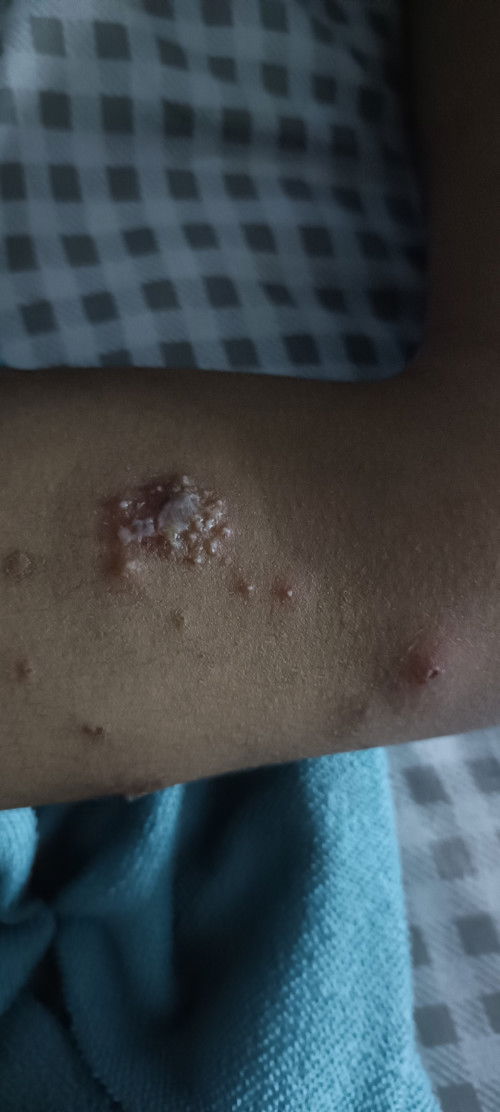 ลูกเป็นแผล