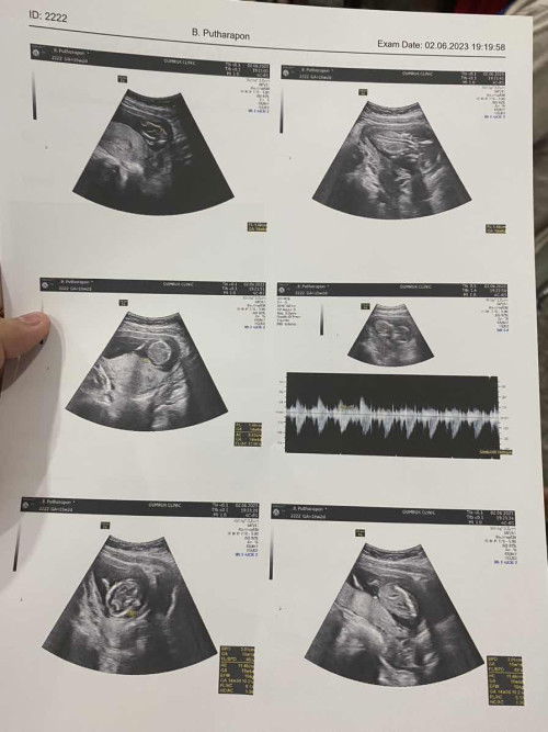 เด็กน้อย 15 w 2 d