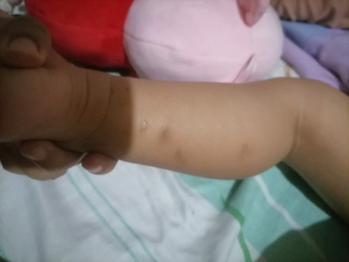 scars/darkspot insect bites