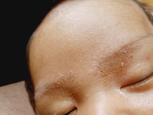 Cradle Cap?