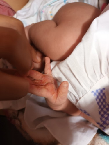 น้องพึ่งอายุได้15วัน แต่มีผื่นเป็นตุ่มหนองขึ้นที่มือเกิดจากอะไรคะ