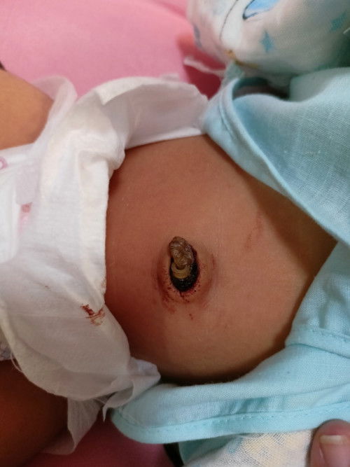 สะดือเด็ก 5 วัน