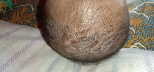 Luka pada kepala bayi 6-12 bulan