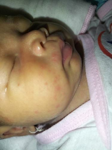 Bé nhà em được 10 ngày tuổi, mà cơ thể nỗi rôm sảy ở mặt, môg. Mong các mom chỉ giúp cách trị với ạ