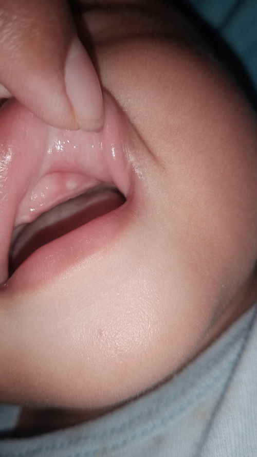 Gumgi apa sariawan bun