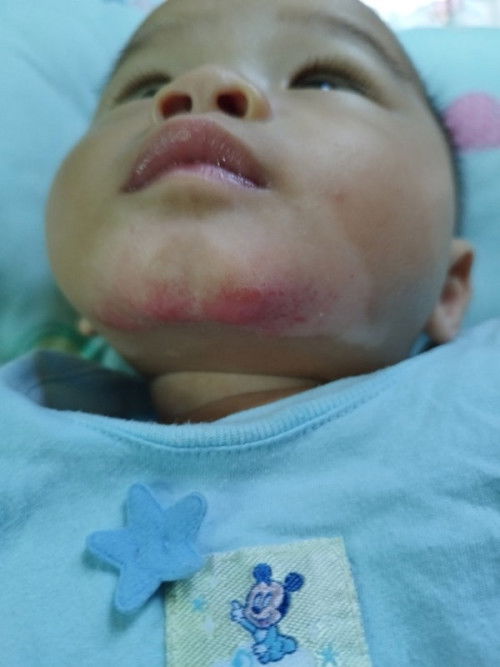 RUAM PADA DAGU DAN LEHER BABY 5BULAN 23HARI