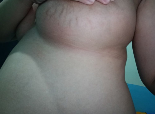 Stretchmarks sa ilalim ng dibdib