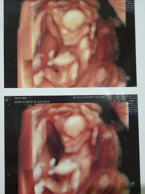 Mom nào tinh mắt nhìn giúp m vs ạ. Bs k báo giới tính m hơi tò mò☺️☺️