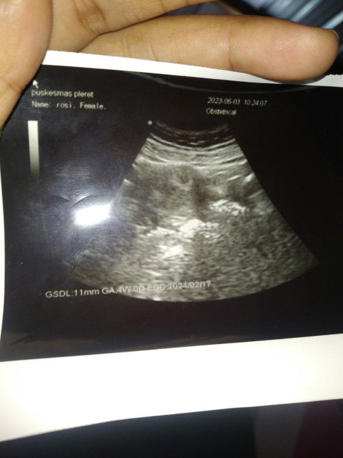 Tadi siang saya periksa kehamilan bun, usia kehamilan baru 2 minggu, di tespeck sudah positif, saya