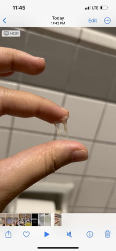 Is this discharge normal?