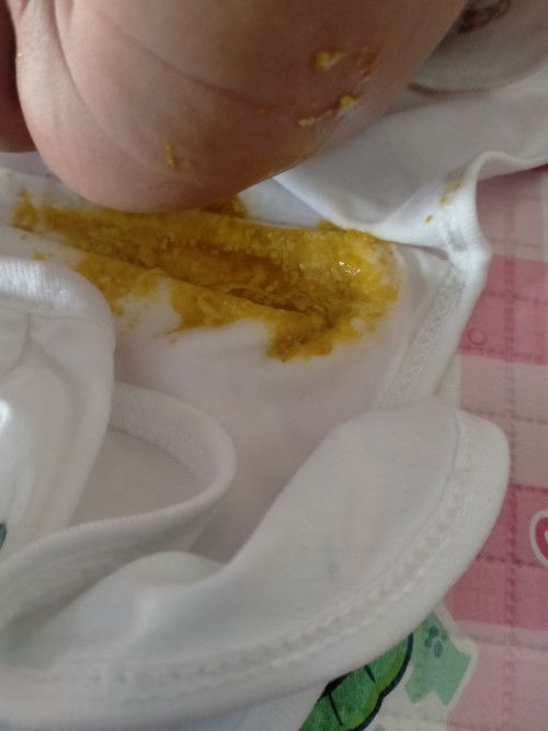 Bayi usia 1 bulan, perut berbunyi keroncongan, BAB lebih dr 12x. Sehari tp sedikit-sedikit.