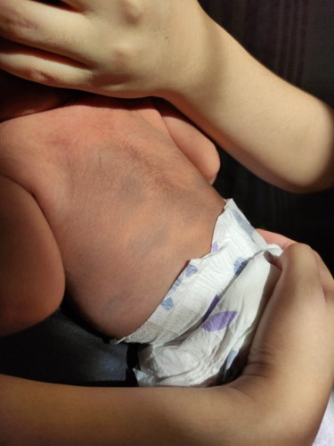 Hello po, normal lang po ba to sa newborn na may bluish or greenish sa likod niya?