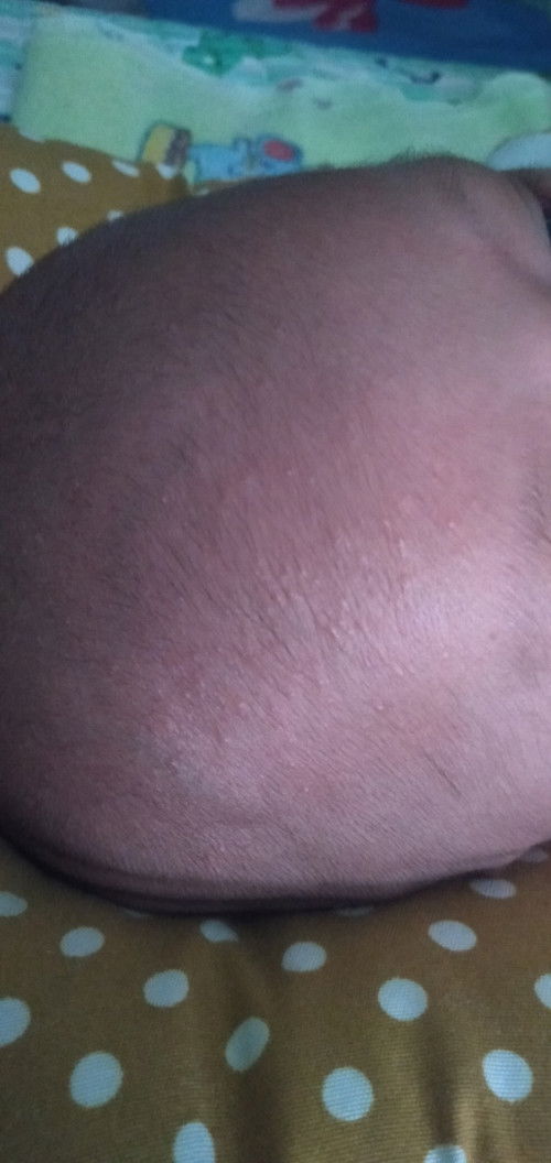 Pipi dan kepala bayi bintik²