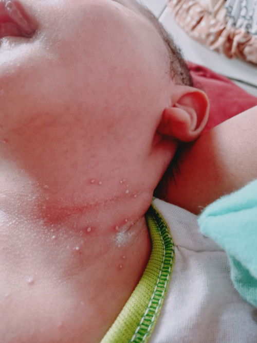 Penghilanhg bintik merah