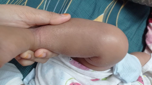 Kulit kering sensitif