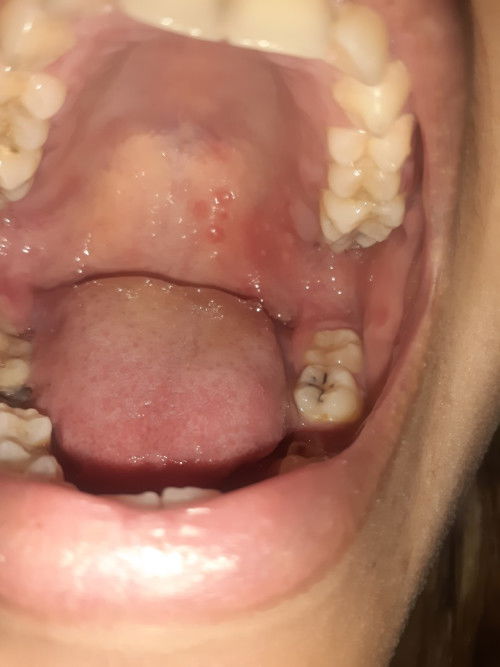 Gusi bengkak dan bintik² di lidah sama tenggorokan