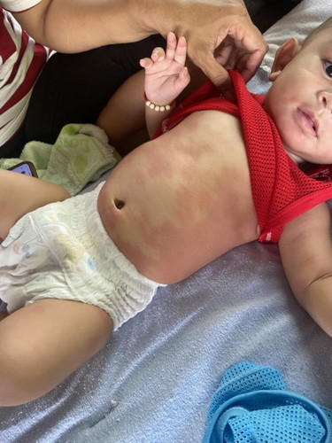 ผื่นแบบนี้อันตรายไหมคะ