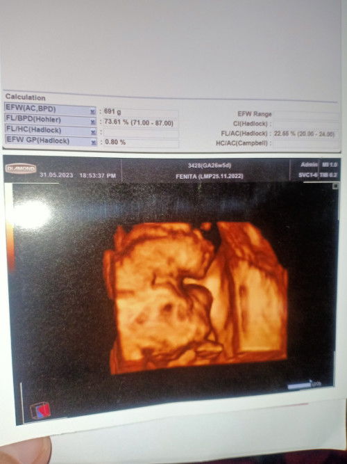 Hasil USG tentang usia kehamilan beda dgn Hpht