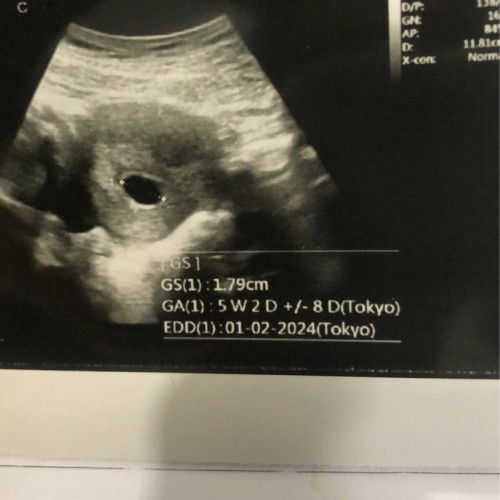 HpHT dan USG berbeda jauh