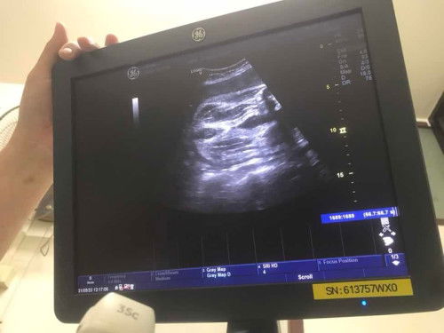 ไปซาวด์2ที่แต่หมอบอกไม่ตรงกัน?